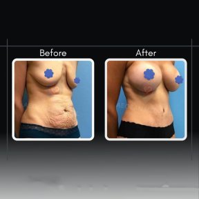 Resultados de abdominoplastia antes y después en Assoc.Prof.Dr.Cemal Kara / Medical Park İzmir Hospital