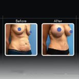Resultados de abdominoplastia antes y después en Assoc.Prof.Dr.Cemal Kara / Medical Park İzmir Hospital