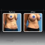 Vorher-nachher-Ergebnisse Bauchdeckenstraffung und Liposuktion bei Dr. Cemal Kara