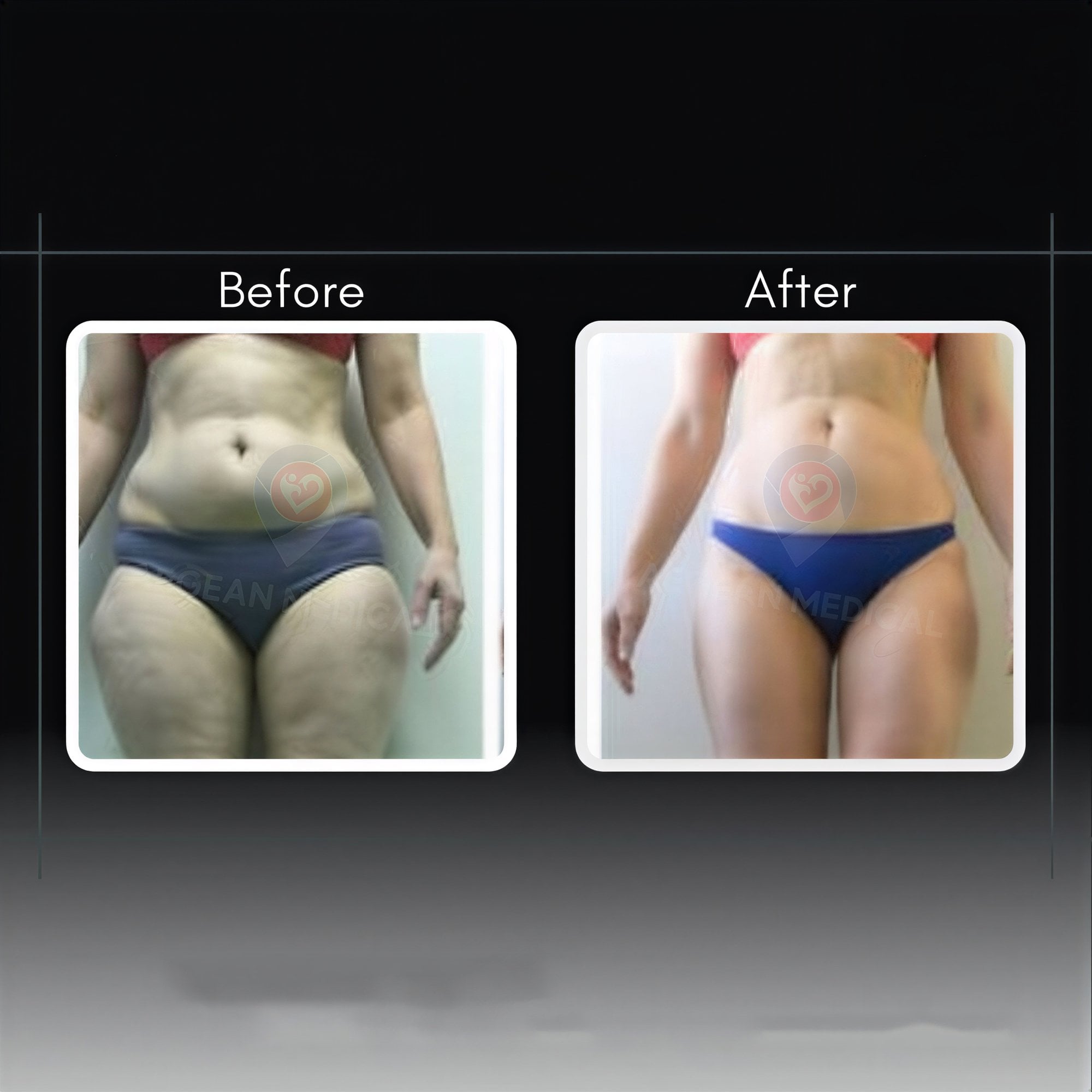 Resultados de abdominoplastia y liposucción antes y después en la clínica Dr. Cemal Kara