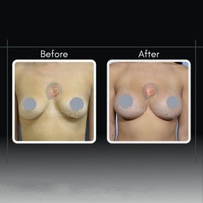 Resultados antes y después de aumento de senos en Assoc.Prof.Dr.Cemal Kara / Medical Park İzmir