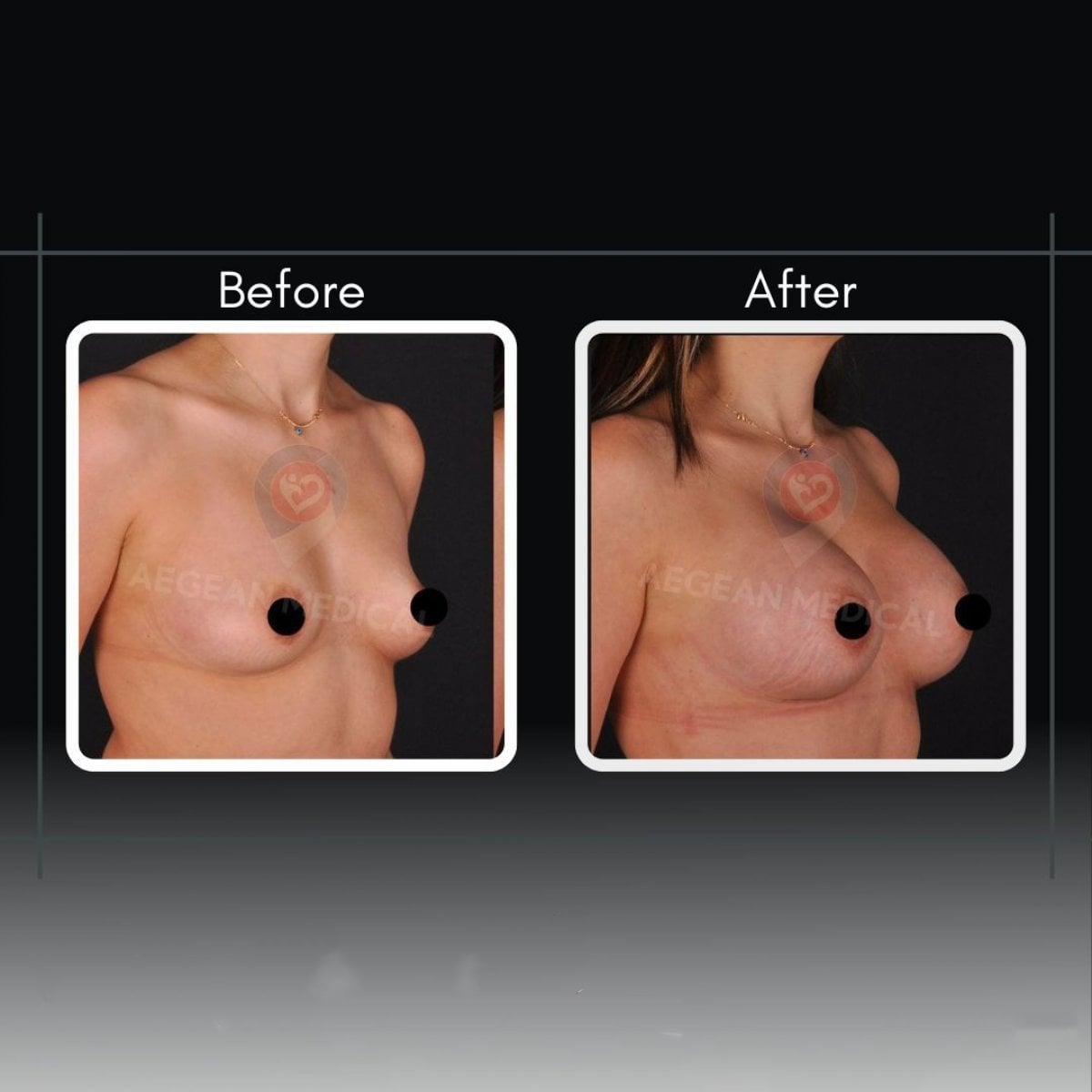 Resultados antes y después de aumento de senos en Assoc.Prof.Dr.Cemal Kara / Medical Park İzmir