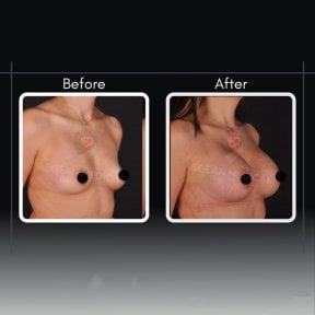 Результаты до и после увеличения груди в Assoc.Prof.Dr.Cemal Kara / Medical Park İzmir