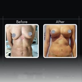 Результаты до и после увеличения груди в клинике Assoc.Prof.Dr.Cemal Kara / Medical Park İzmir Hospital