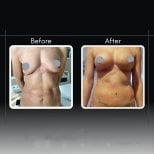 Результаты до и после увеличения груди в клинике Assoc.Prof.Dr.Cemal Kara / Medical Park İzmir Hospital