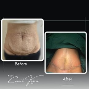 Vorher-nachher-Liposuktionsergebnisse bei Assoc.Prof.Dr.Cemal Kara / Medical Park İzmir