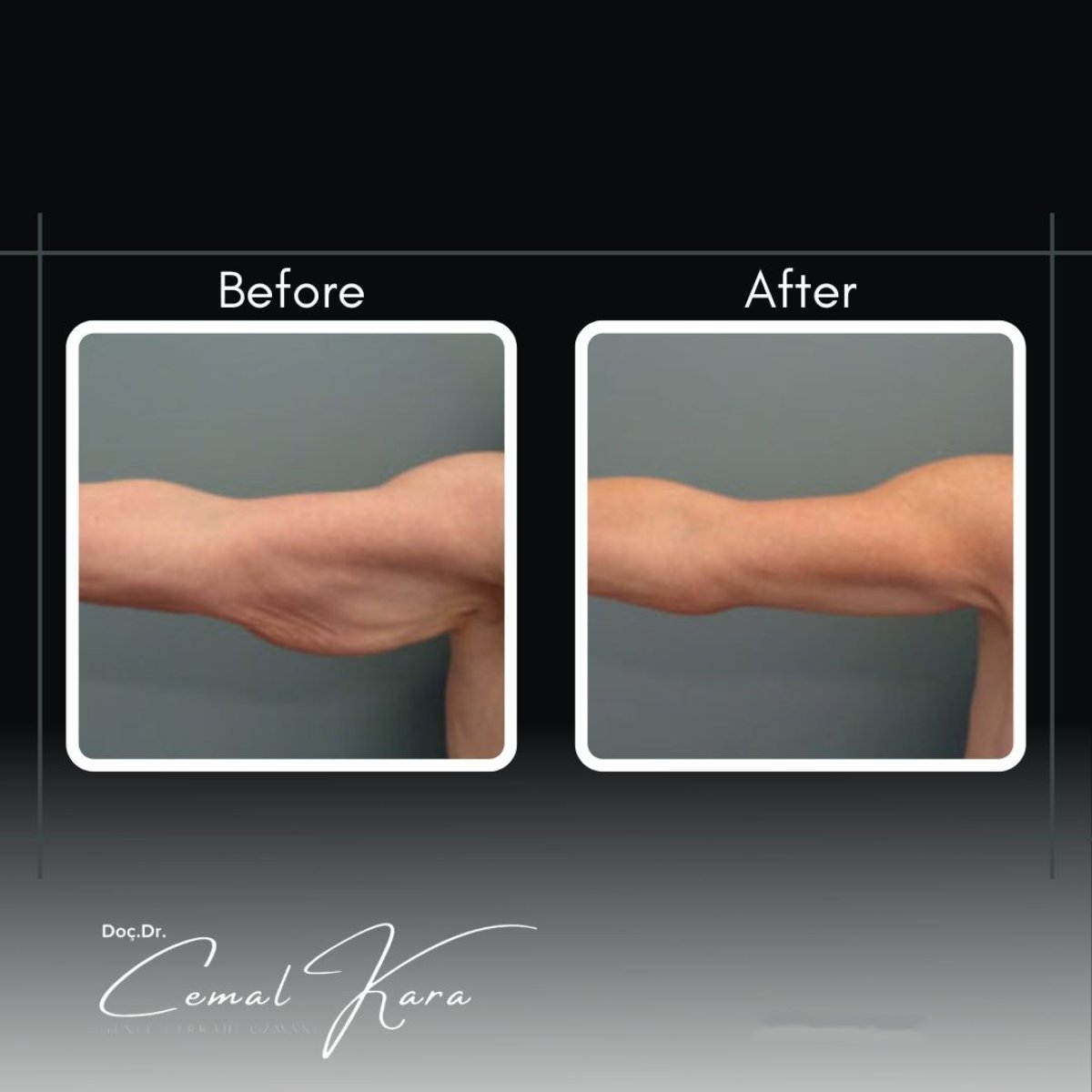 Resultados de liposucción de brazos antes y después en Assoc.Prof.Dr.Cemal Kara / Medical Park İzmir