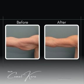 Vorher-nachher-Ergebnisse der Armliposuktion bei Assoc.Prof.Dr.Cemal Kara / Medical Park İzmir