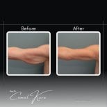 Vorher-nachher-Ergebnisse der Armliposuktion bei Assoc.Prof.Dr.Cemal Kara / Medical Park İzmir