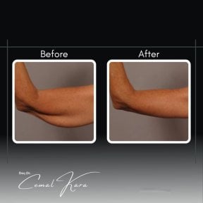 Vorher-nachher-Ergebnisse der Armliposuktion bei Assoc.Prof.Dr.Cemal Kara / Medical Park İzmir Hospital