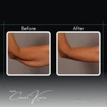 Vorher-nachher-Ergebnisse der Armliposuktion bei Assoc.Prof.Dr.Cemal Kara / Medical Park İzmir Hospital