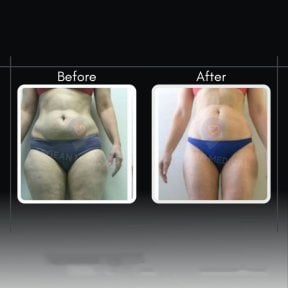 Liposuktion Vorher-Nachher-Ergebnisse bei Assoc.Prof.Dr.Cemal Kara / Medical Park İzmir Hospital