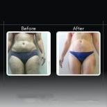 Liposuktion Vorher-Nachher-Ergebnisse bei Assoc.Prof.Dr.Cemal Kara / Medical Park İzmir Hospital