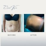 Liposuktion Vorher-Nachher-Ergebnisse bei Assoc.Prof.Dr.Cemal Kara / Medical Park İzmir Hospital