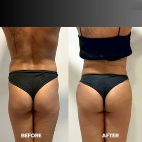 Before and after liposuction results at ID Clinic Bangkok, improved waist and body contour