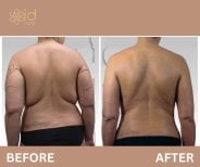 Before and after liposuction results at ID Clinic Bangkok – visible back contour improvement