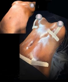 Before and after breast lift results at Dr. MED, visible breast contour improvement