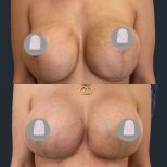 Before and after breast implant revision results at Dr. MED , improved breast shape