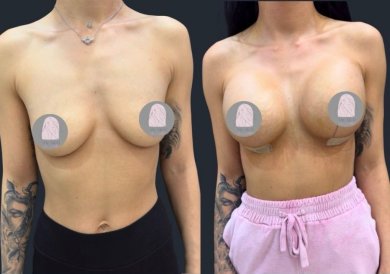 Before and after breast lift results at Dr. MED clinic, visible breast contour improvement