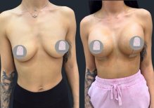 Before and after breast lift results at Dr. MED clinic, visible breast contour improvement