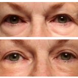 Before and after Morpheus8 skin tightening results around eyes at Clinica Granado Tiagonce