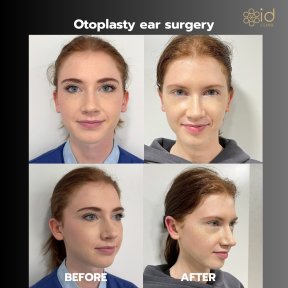 Before and after otoplasty results at ID Clinic Bangkok, ear reshaping surgery improvement