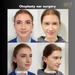 Before and after otoplasty results at ID Clinic Bangkok, ear reshaping surgery improvement
