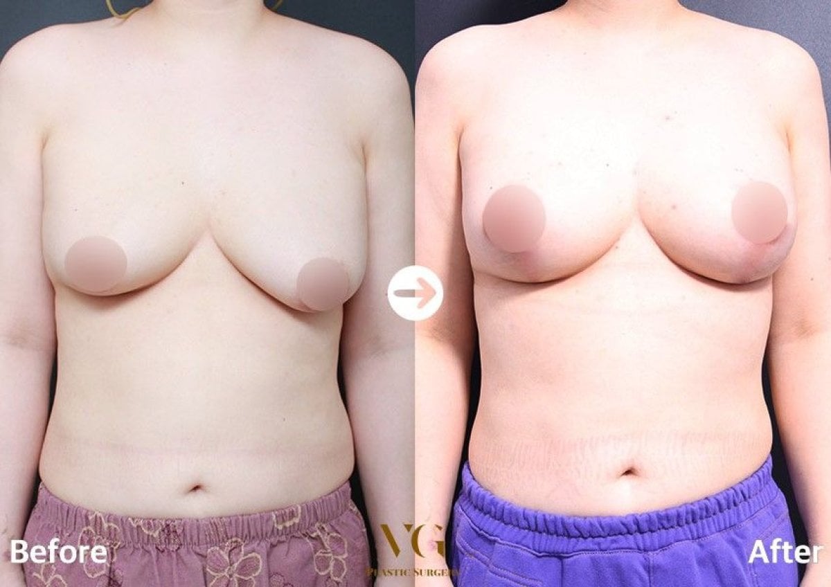 نتائج تصغير الثدي قبل وبعد في VG Plastic Surgery، تحسين شكل وحجم الثدي