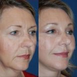 Результаты до и после deep plane facelift в Memorial Şişli Hospital, омоложение лица