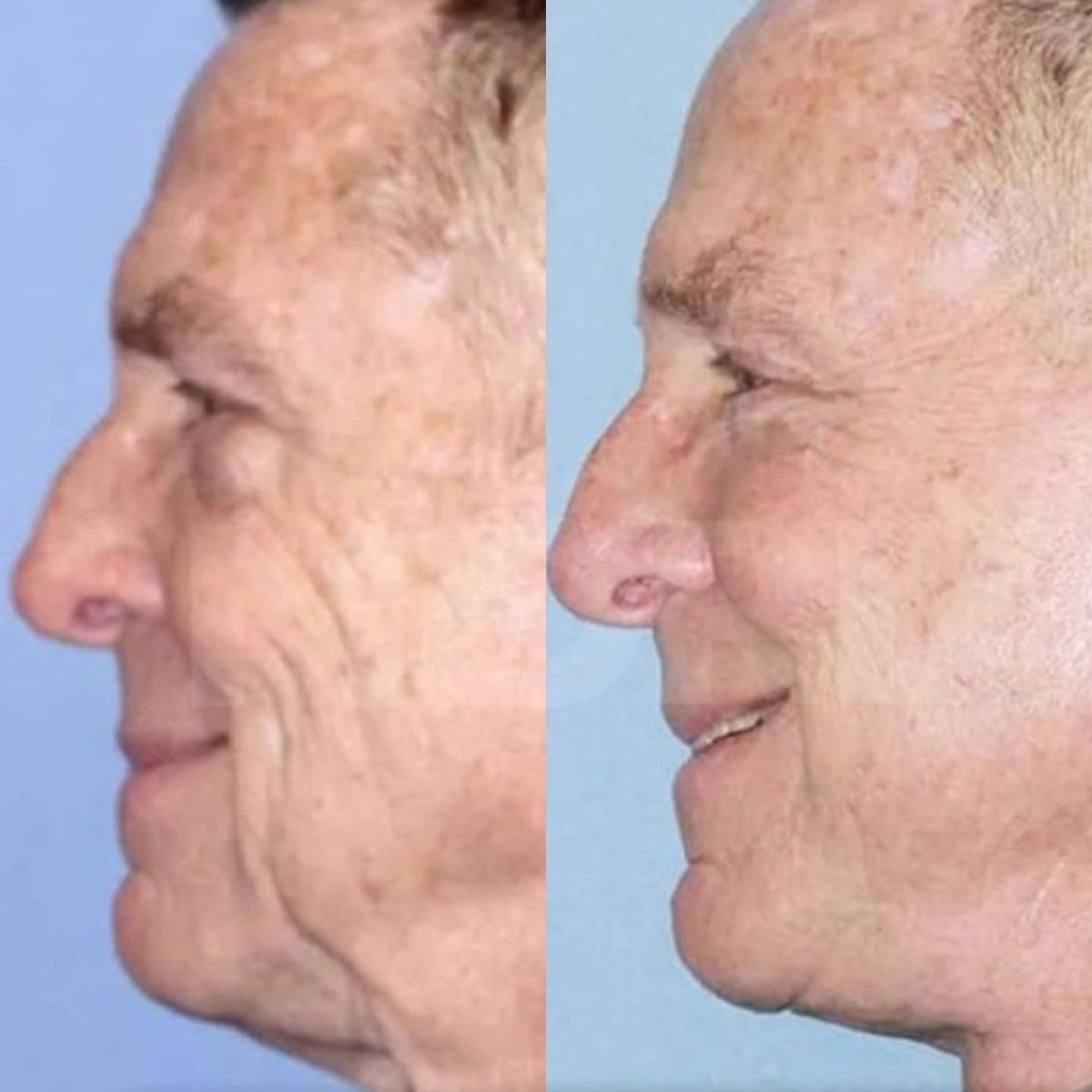Resultados antes y después de deep plane facelift en Memorial Şişli Hospital, rejuvenecimiento facial