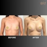 Resultados de aumento de senos antes y después en ID Clinic Bangkok, forma mejorada