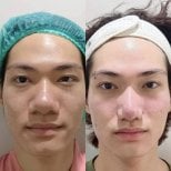 Resultados de rinoplastia antes y después en Charismma Clinic, remodelación nasal natural