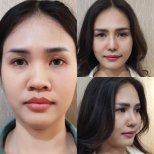 Resultados de rinoplastia antes y después en Charismma Clinic, nariz de aspecto natural