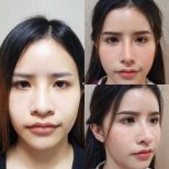 Resultados de rinoplastia antes y después en Charismma Clinic, remodelación de la nariz
