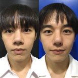 Resultados de rinoplastia antes y después en Charismma Clinic, mejor forma y simetría nasal