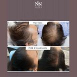 Vorher-nachher Haarmesotherapie bei Namninforv Clinic – sichtbares Haarwachstum