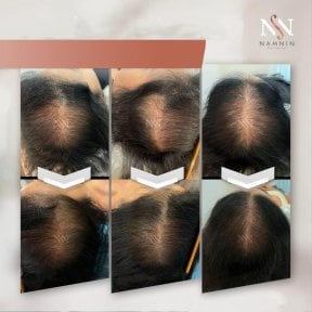 Vorher-nachher-Ergebnisse der Haarmesotherapie in der Namninforv Clinic – mehr Haardichte