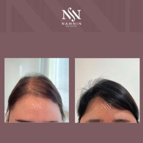 Vorher-nachher-Ergebnis der Haarmesotherapie in der Namninforv Clinic, dichteres Haar