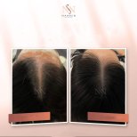 Vorher-nachher-Ergebnisse der Haarmesotherapie bei Namninforv Clinic – dichteres Haar
