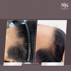 Vorher-nachher-Ergebnis der Haarmesotherapie bei Namninforv Clinic, dichteres Haar