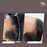 Vorher-nachher-Ergebnis der Haarmesotherapie bei Namninforv Clinic, dichteres Haar
