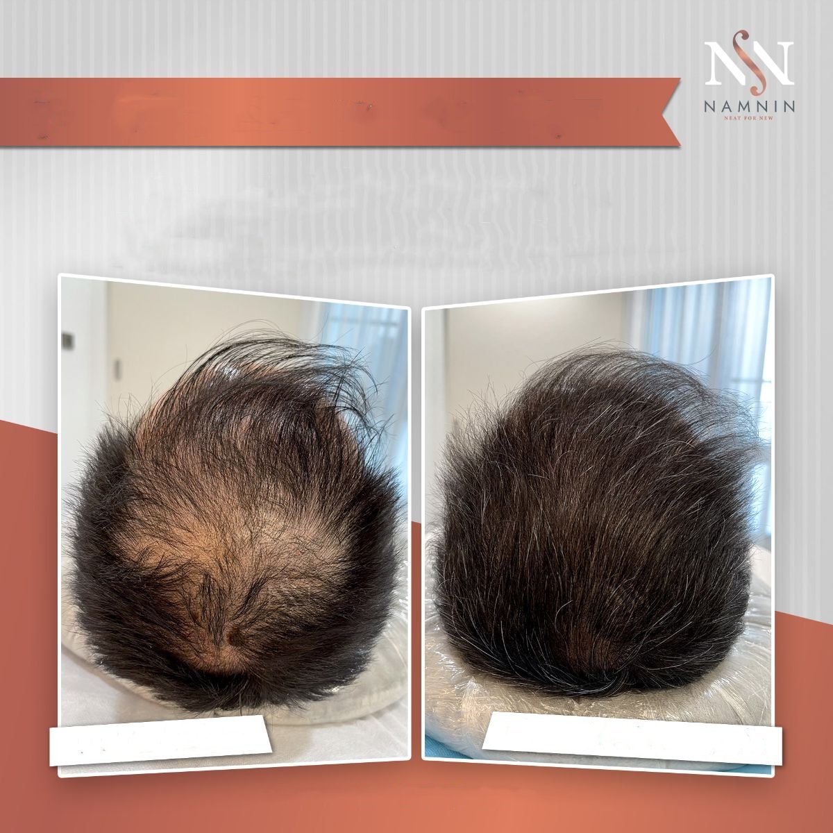 قبل وبعد علاج ميزوثيرابي الشعر في عيادة Namninforv، تحسن كثافة الشعر