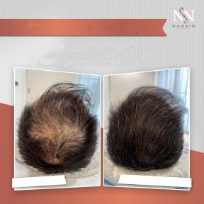 Vorher-nachher-Ergebnis Haarmesotherapie bei Namninforv Clinic, sichtbare Haardichte