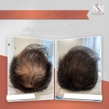 Vorher-nachher-Ergebnis Haarmesotherapie bei Namninforv Clinic, sichtbare Haardichte