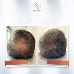 Vorher-nachher-Ergebnis der Haarmesotherapie in der Namninforv Clinic, dichtere Kopfhaut