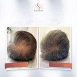 Vorher-nachher-Ergebnis der Haarmesotherapie in der Namninforv Clinic, dichtere Kopfhaut