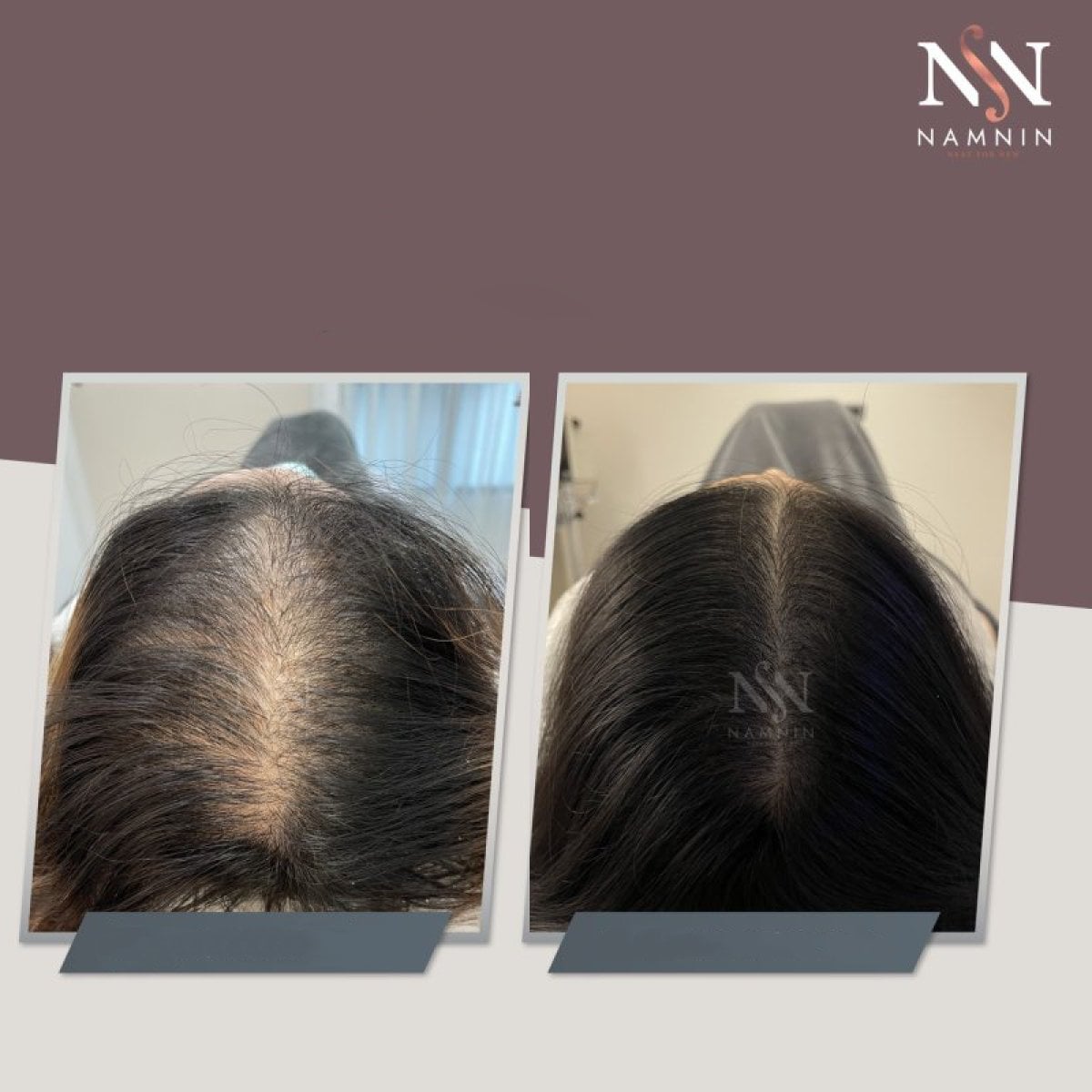 Resultados de mesoterapia capilar antes y después en Namninforv Clinic, mayor densidad