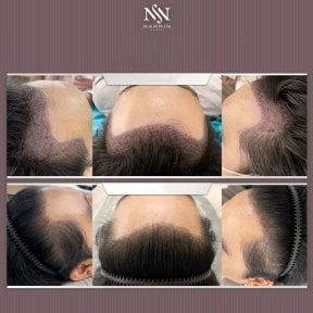 Vorher-nachher-Ergebnisse Haartransplantation bei Namninforv Clinic, volle Haarlinie