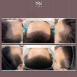 Vorher-nachher-Ergebnisse Haartransplantation bei Namninforv Clinic, volle Haarlinie