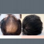 Vorher-nachher-Ergebnis Haartransplantation bei Namninforv Clinic – dichteres Haar